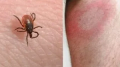 Kako se prenosi borrelioza (lyme bolest)?